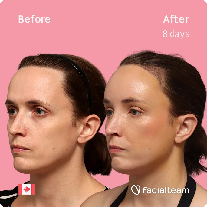 Quadratische Schrägaufnahme des linken Profils von Erin, die ihre Vorher-Nachher-Transformation der FFS mit Facialteam zeigt: Stirn mit SHT.