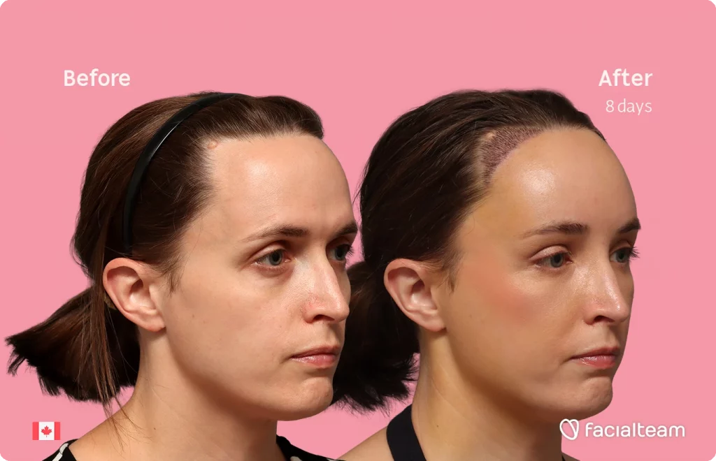 Seitenansicht des rechten Profils von Erin mit den Vorher-Nachher-Ergebnissen ihrer FFS bei Facialteam: Stirnfeminisierung mit SHT.