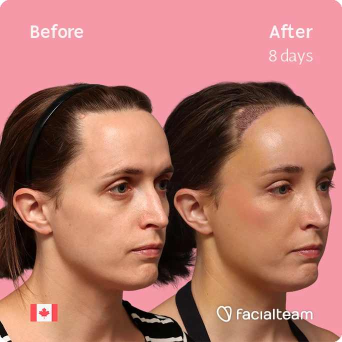 Quadratische Seitenansicht des rechten Profils von Erin mit den Vorher-Nachher-Ergebnissen ihrer FFS bei Facialteam: Stirnfeminisierung mit SHT.