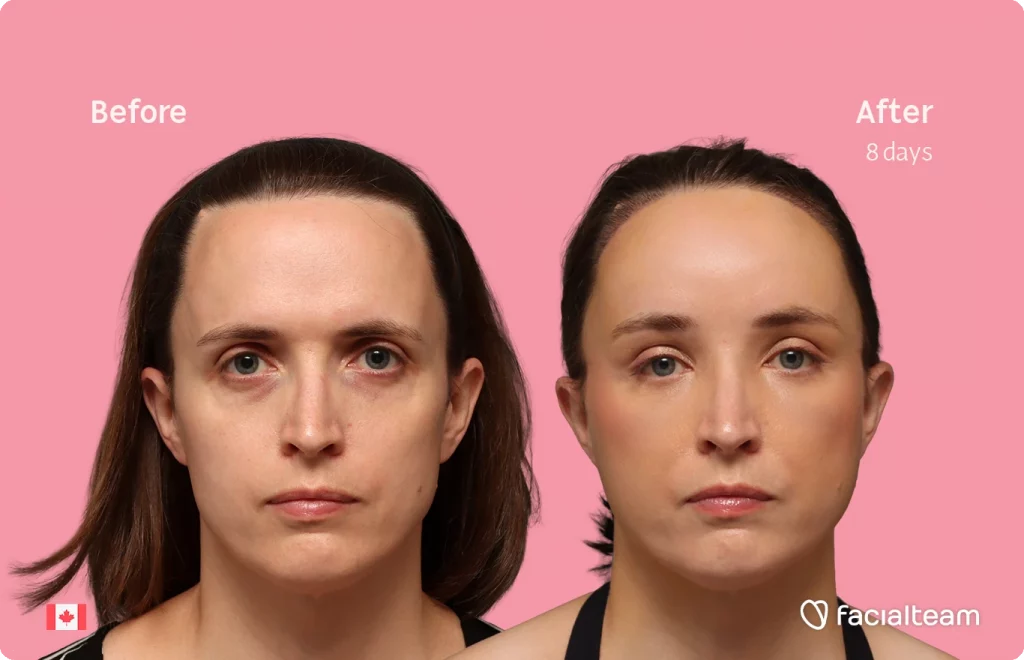 Frontansicht von Erin, die ihre Vorher-Nachher-Transformation der FFS mit Facialteam zeigt: Stirn mit SHT.