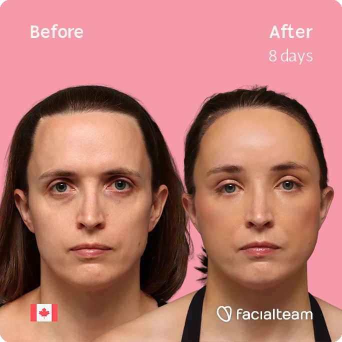 Quadratische Frontansicht von Erin, die ihre Vorher-Nachher-Transformation der FFS mit Facialteam zeigt: Stirn mit SHT.