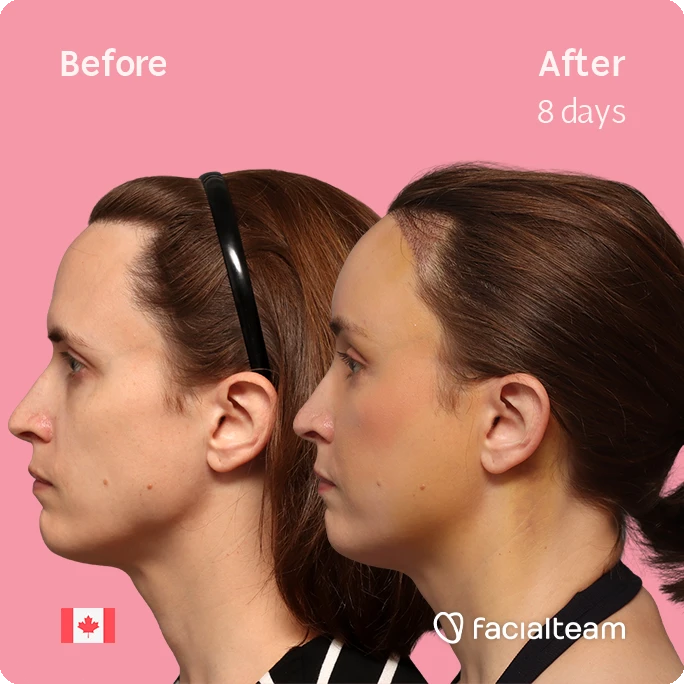 Quadratische Seitenansicht des linken Profils von Erin mit den Vorher-Nachher-Ergebnissen ihrer FFS bei Facialteam: Stirnfeminisierung mit SHT.
