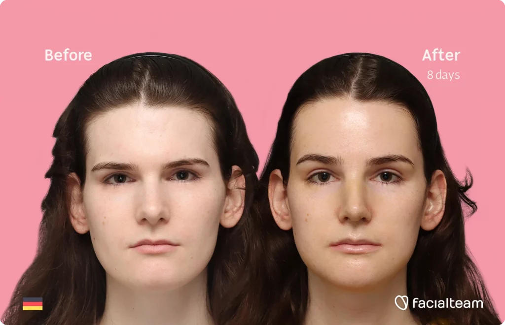 Lena E ffs surgery before and after front